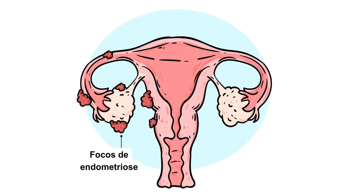 ilustração de focos de endometriose