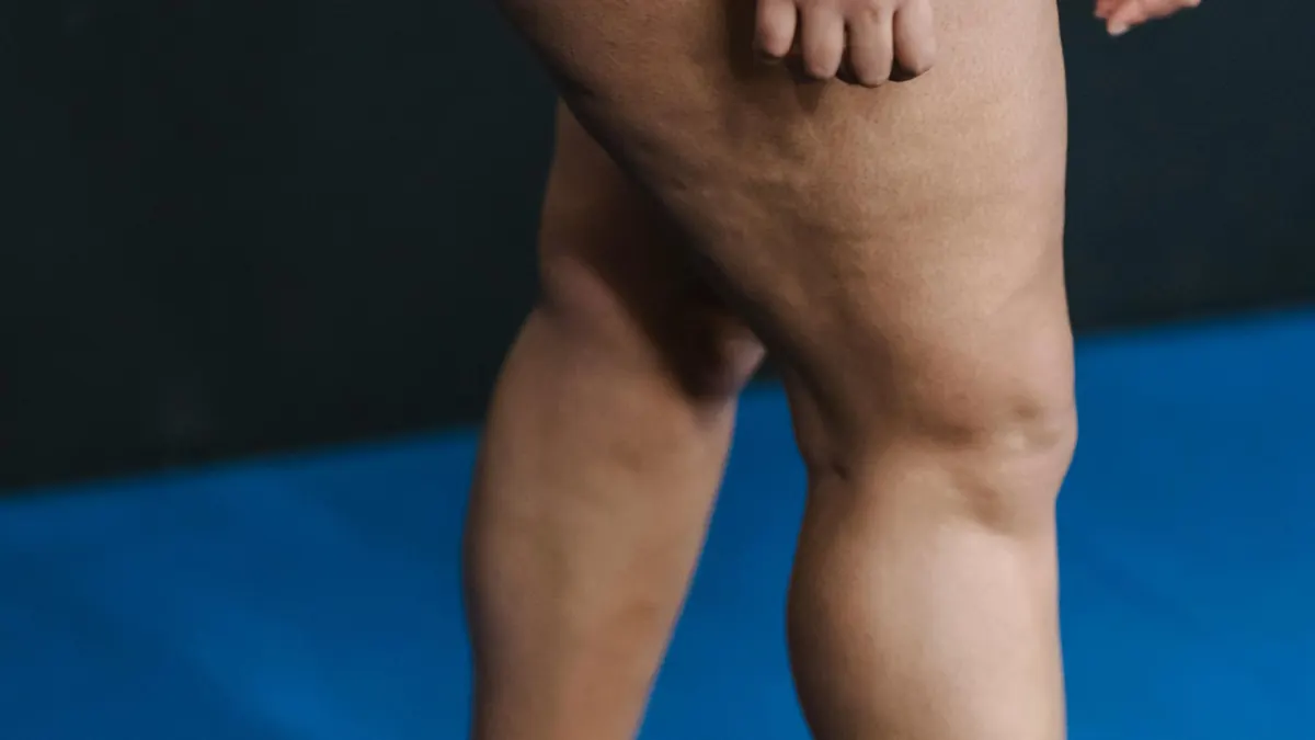 Lipedema perna
