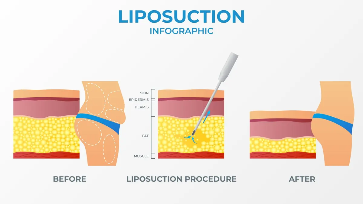 ilustração de uma lipoaspiracao