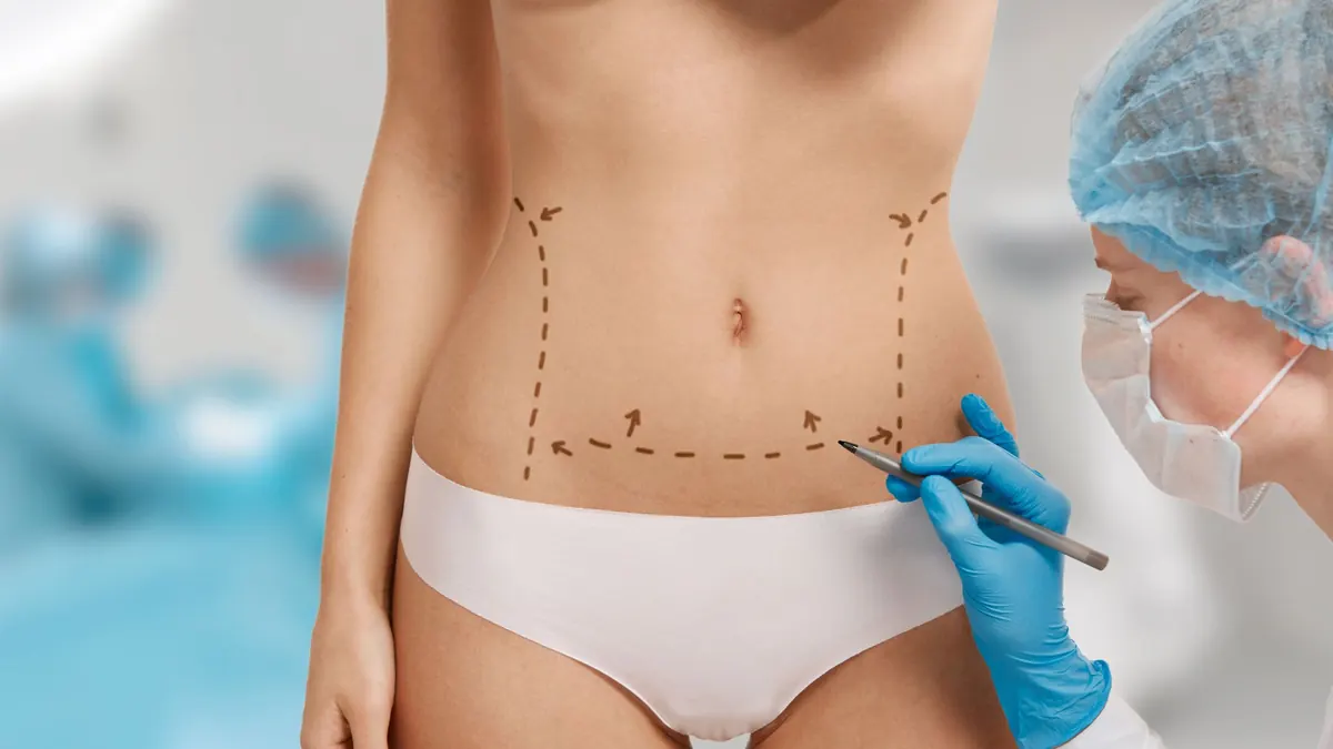 Corpo feminino com marcações para procedimento estético