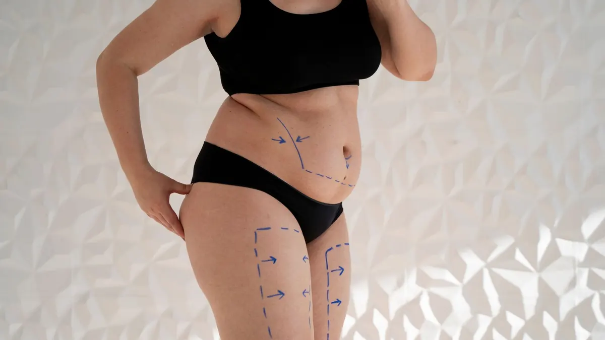Corpo feminino com marcações para procedimento estético
